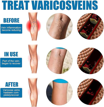 Varicose Veins Treatment