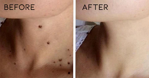 Warts Cure – Remove Warts, Moles & Skin Tags (14 Days Money Back Guarantee)