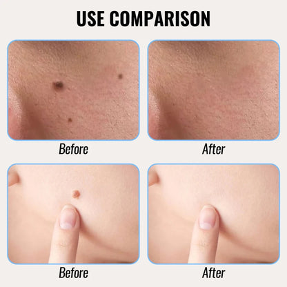 Warts Cure – Remove Warts, Moles & Skin Tags (14 Days Money Back Guarantee)
