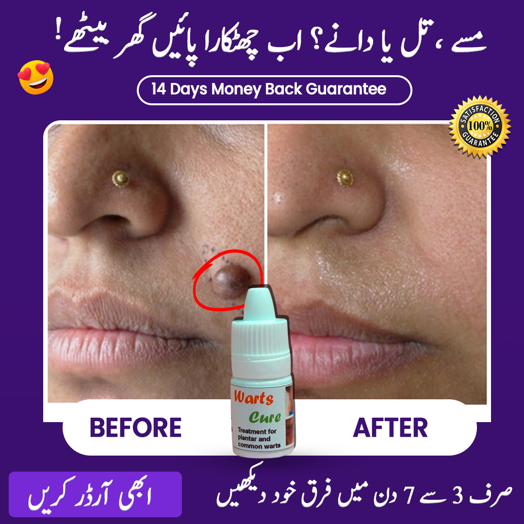 Warts Cure – Remove Warts, Moles & Skin Tags (14 Days Money Back Guarantee)