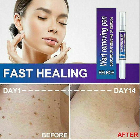 Warts & Moles Remover Pen (14 Days Money Back Guarantee)